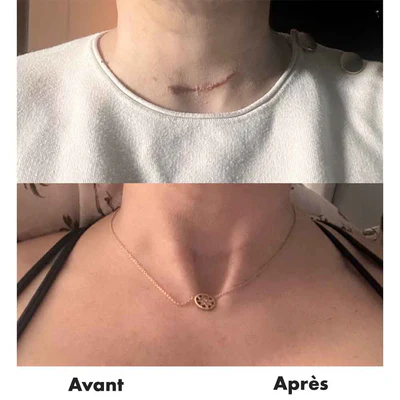avant-après RD Cosmetic cicatrices
