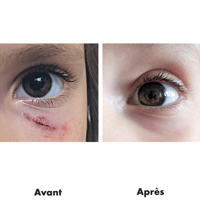 avant-après RD Cosmetic cicatrices