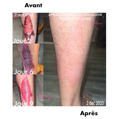 avant-après RD Cosmetic brûlure