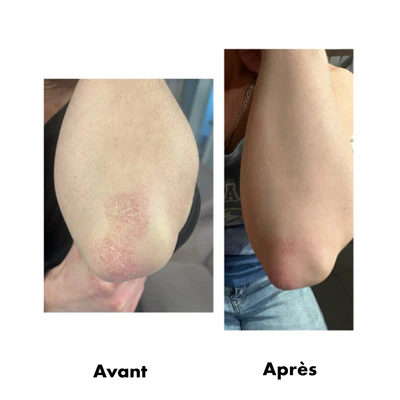 avant-après RD Cosmetic eczéma et psoriasis
