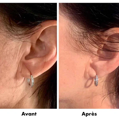avant-après RD Cosmetic régénérant oreilles