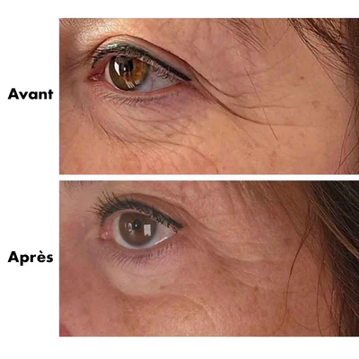 avant-après RD Cosmetic régénérant yeux