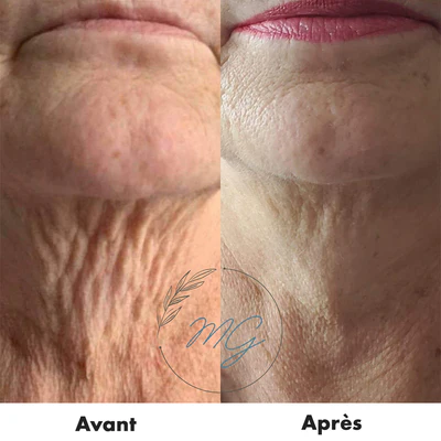 avant-après RD Cosmetic régénérant cou