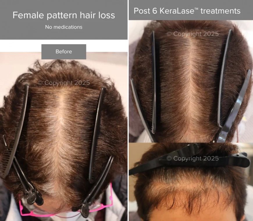 Laser Ultra Cynosure avant-après