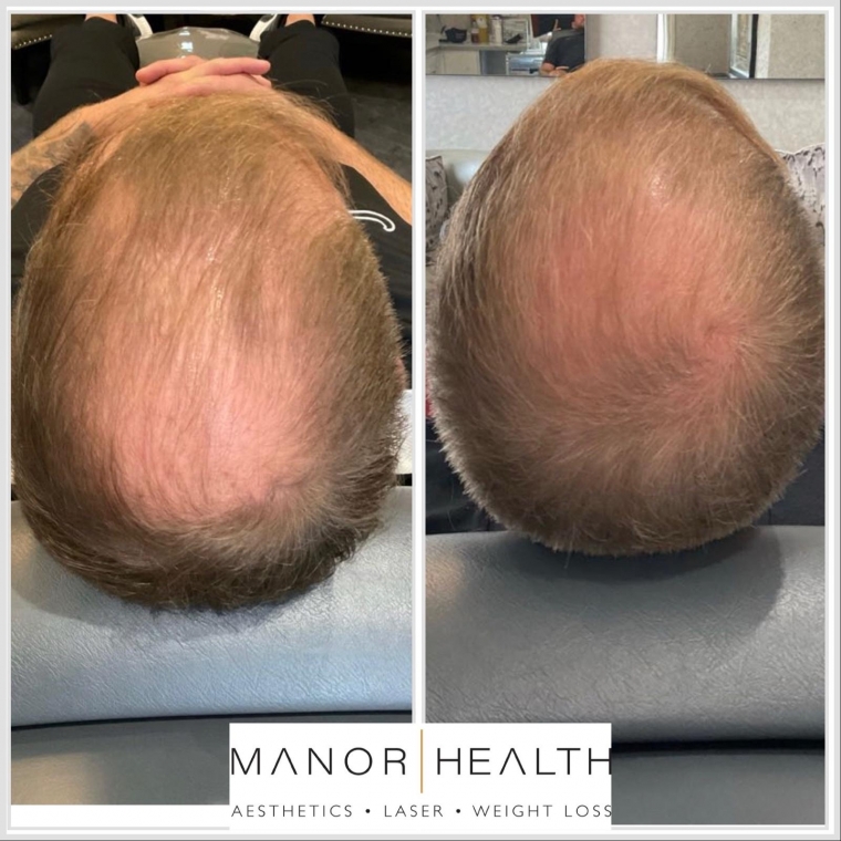 Laser Ultra Cynosure avant-après