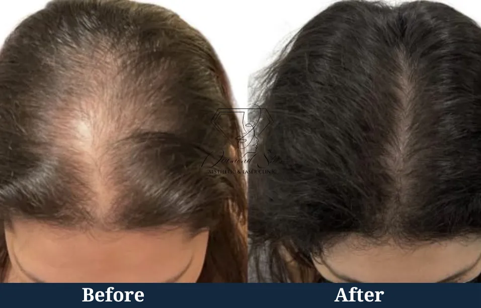 Laser Ultra Cynosure avant-après