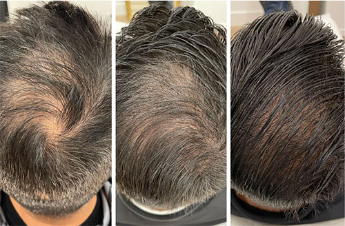 Laser Ultra Cynosure avant-après