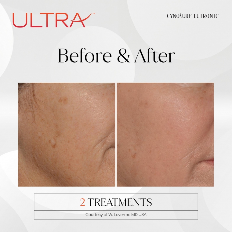 Laser Ultra Cynosure avant-après