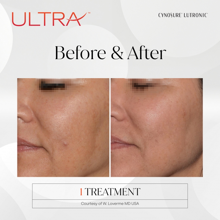 Laser Ultra Cynosure avant-après