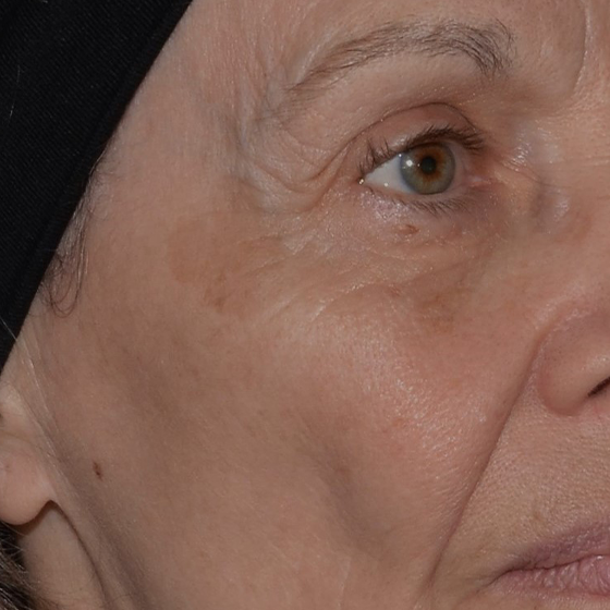 Laser Ultra Cynosure avant-après