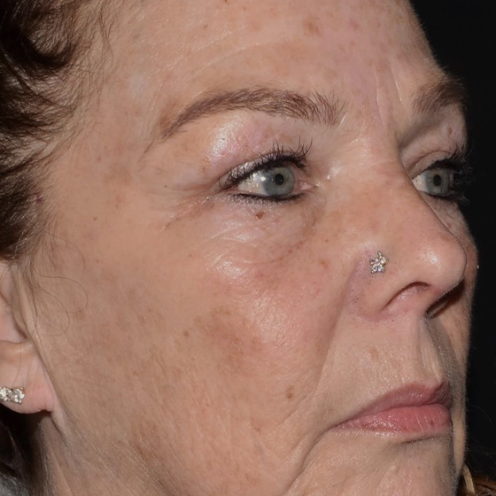 Laser Ultra Cynosure avant-après