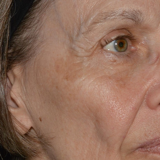 Laser Ultra Cynosure avant-après