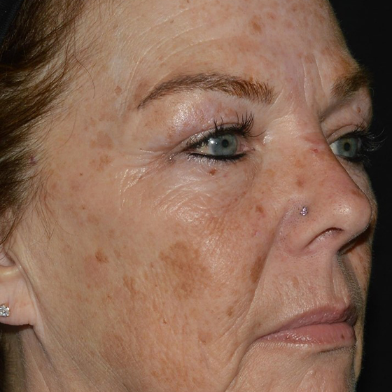 Laser Ultra Cynosure avant-après