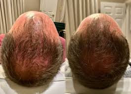 Laser Ultra Cynosure avant-après